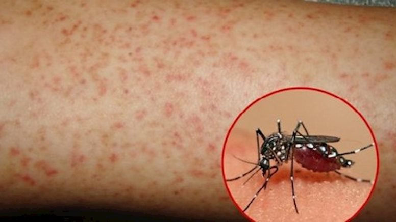 Ảnh 1 của Dengue hemorrhagic fever